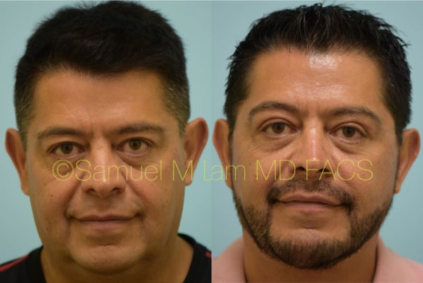 Cheek Augmentation Result Dallas