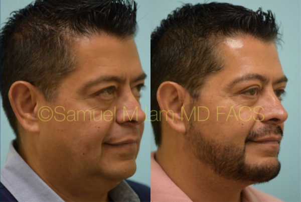 Cheek Augmentation Result Dallas