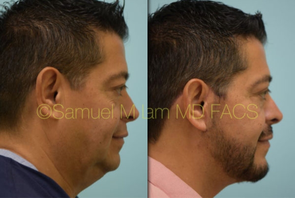 Cheek Augmentation Result Dallas