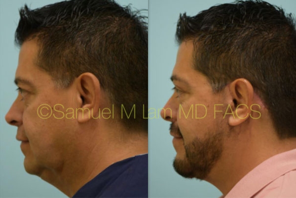 Cheek Augmentation Result Dallas