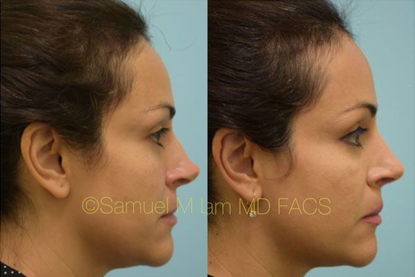Revision Rhinoplasty Photos