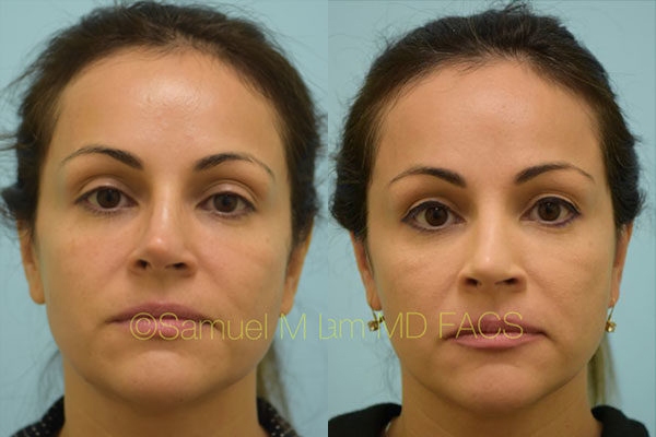 Revision Rhinoplasty Photos