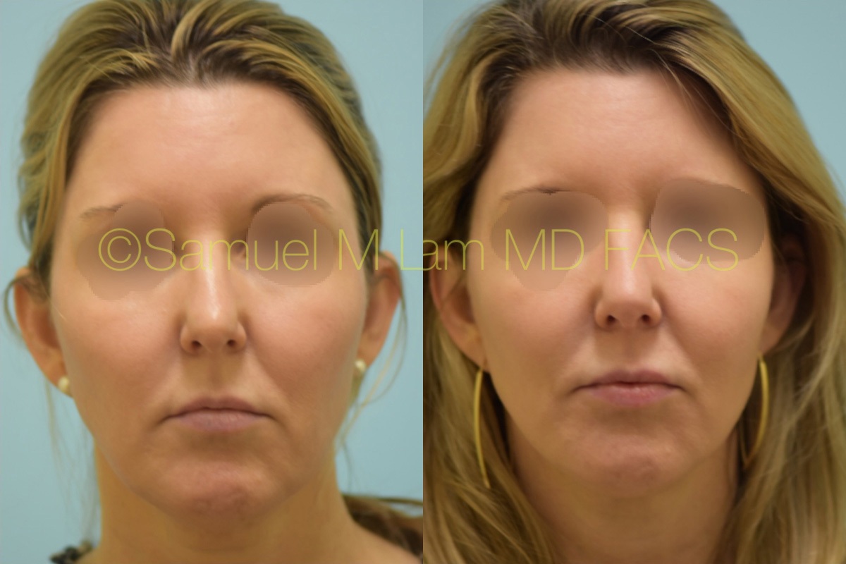 Nasal Tip Rhinoplasty Result Dallas