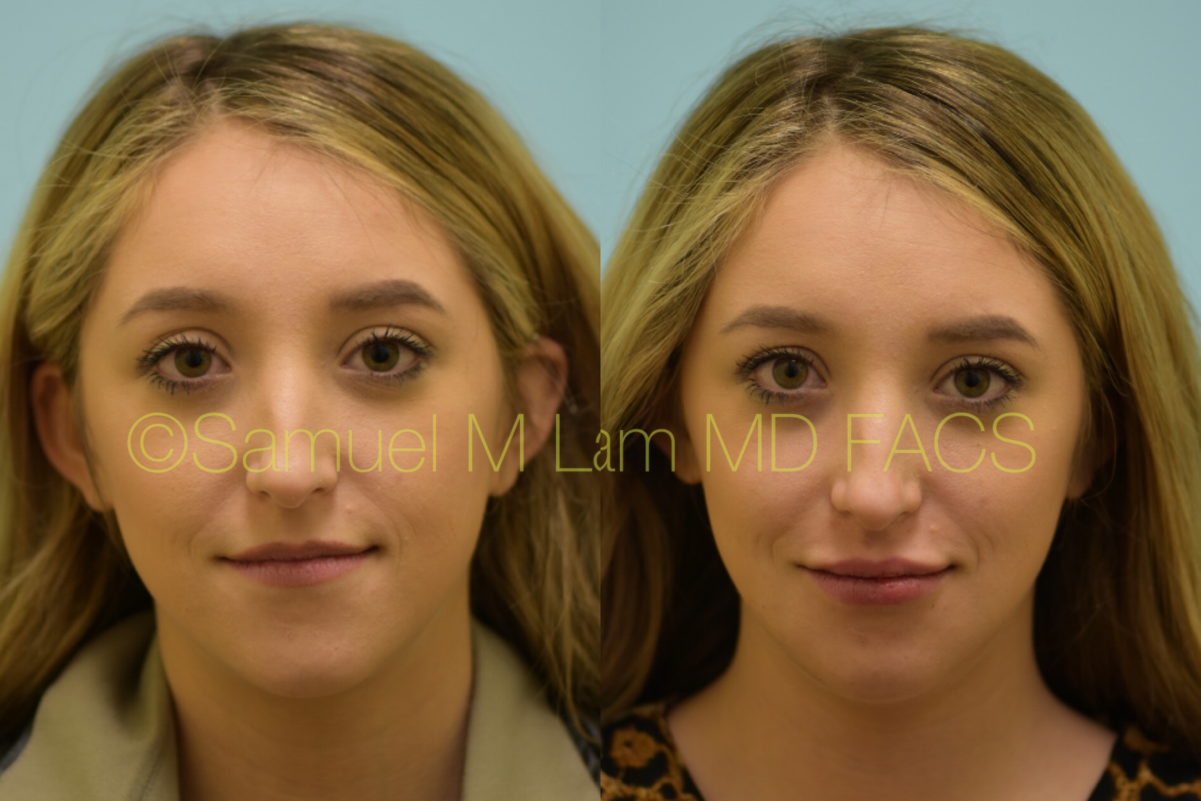 Juvederm Ultra Photos
