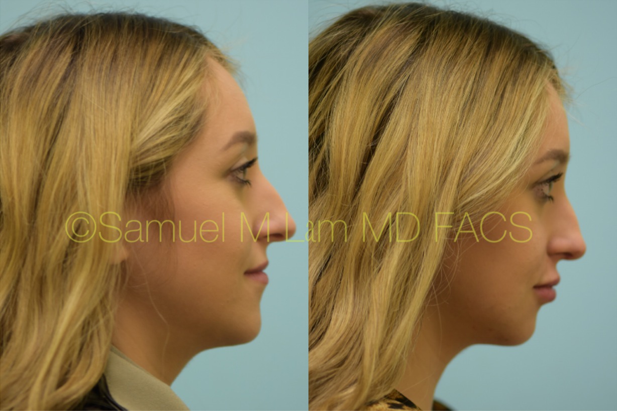Juvederm Ultra Photos