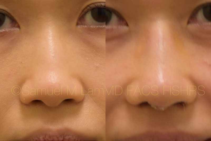 Asian Rhinoplasty Photos
