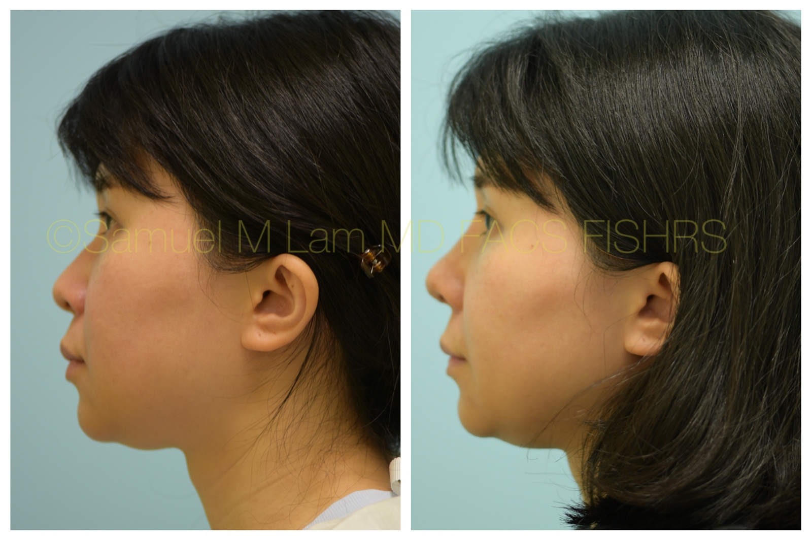 Asian Rhinoplasty Photos