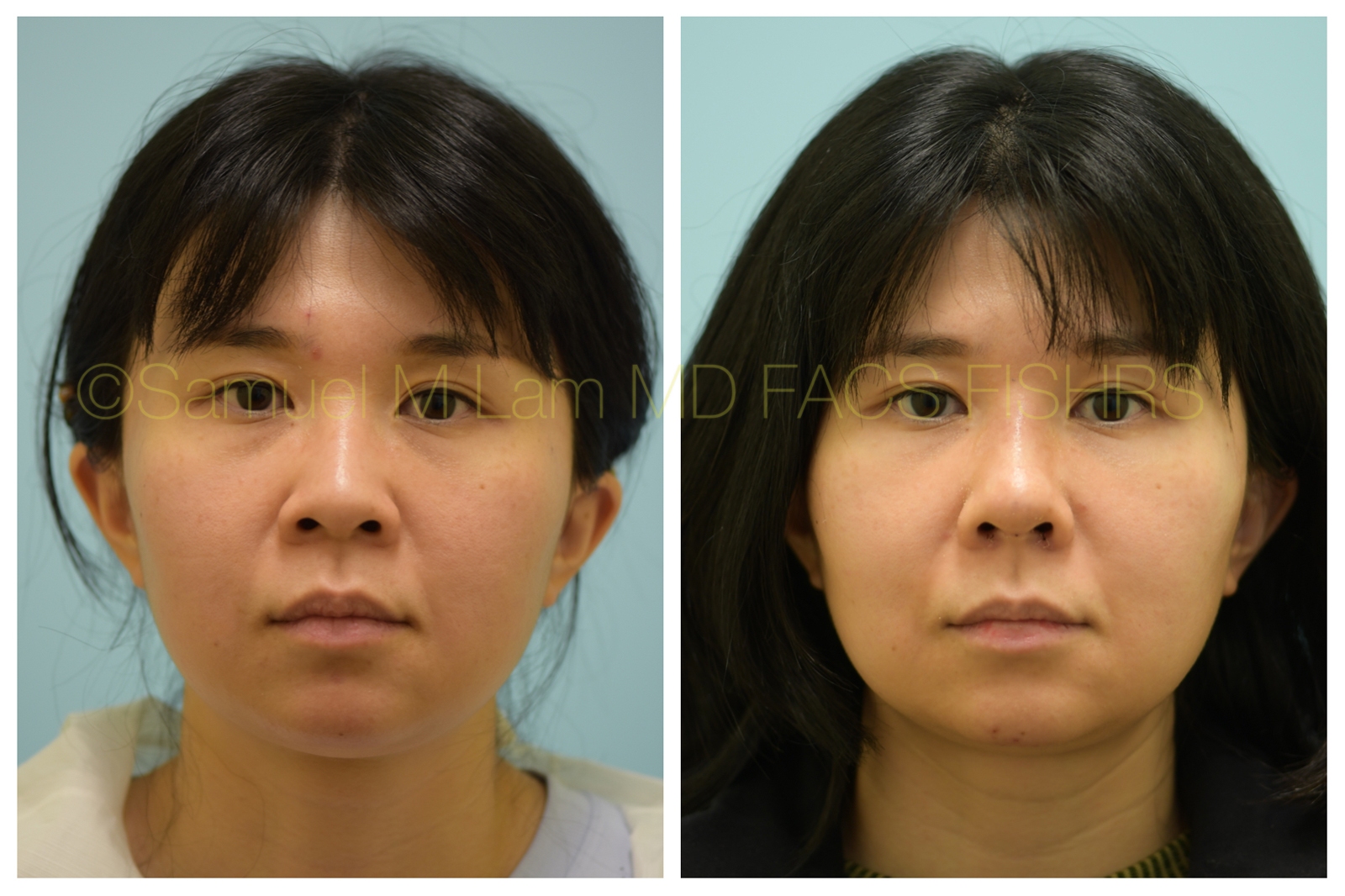 Asian Rhinoplasty Photos