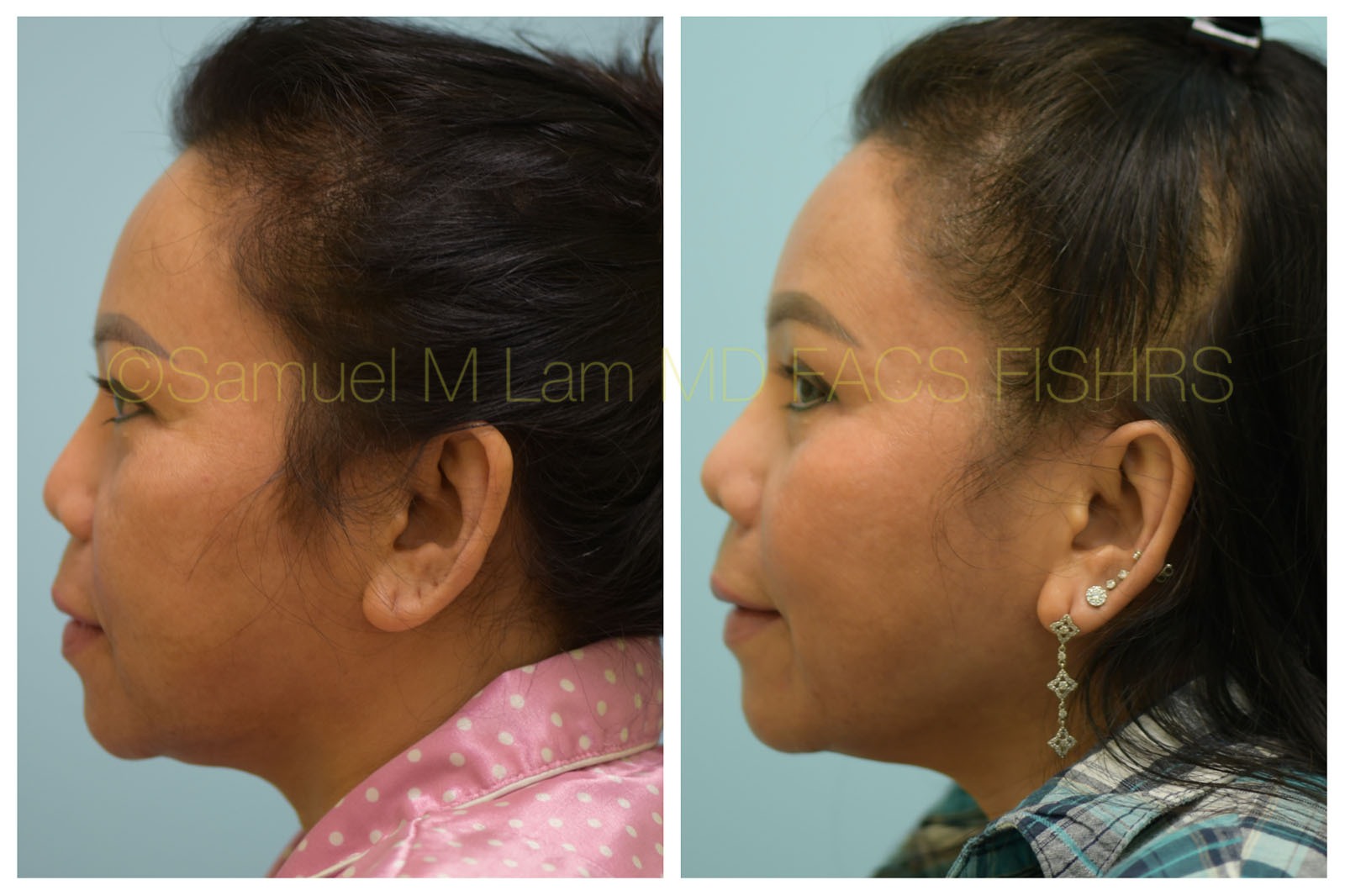 Asian Rhinoplasty Photos