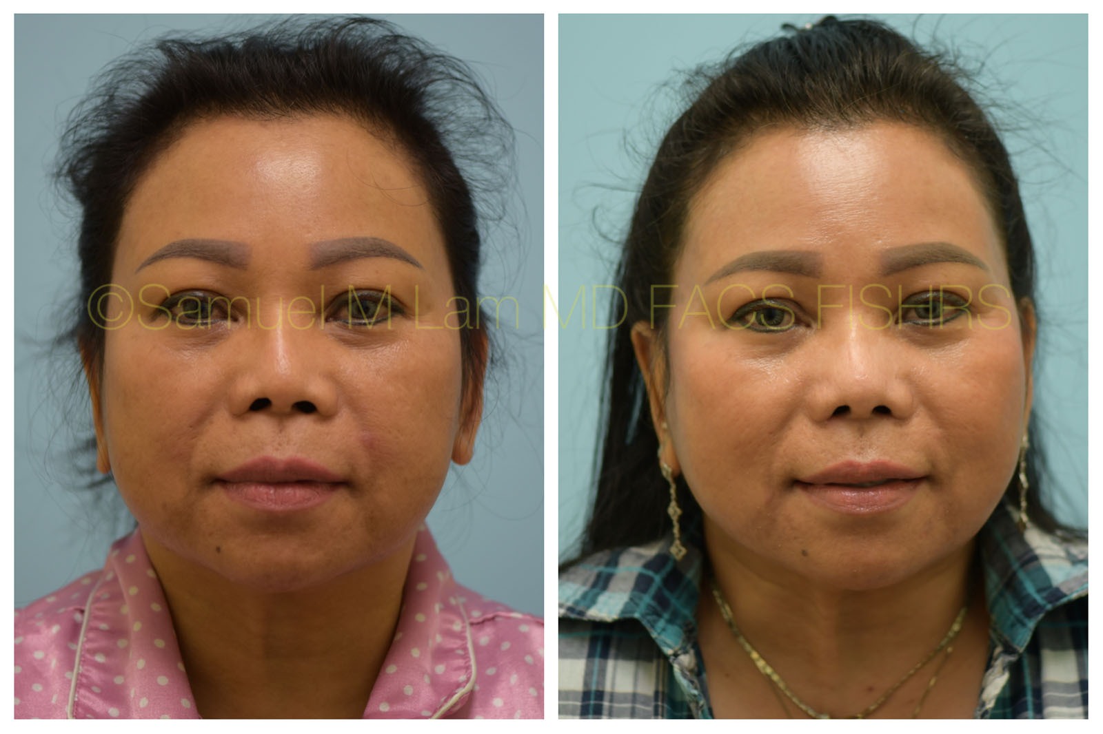 Asian Rhinoplasty Photos