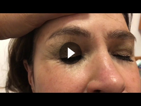 Revision Rhinoplasty Videos