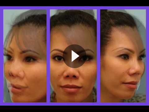 Asian Rhinoplasty Videos
