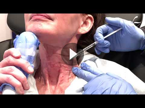 MesoBotox/MicroBotox for Facial Wrinkles Videos