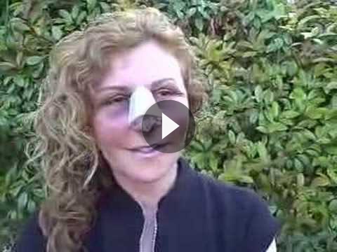 Revision Rhinoplasty Videos