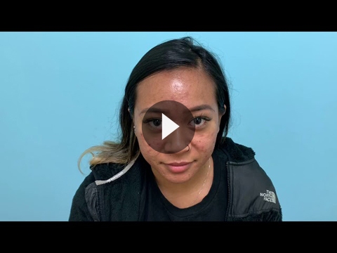 Asian Rhinoplasty Videos