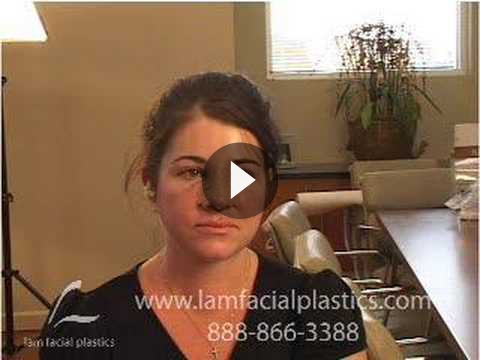 Revision Rhinoplasty Videos