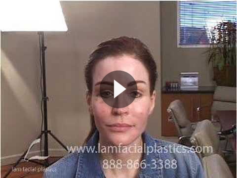 Brow Lift Videos