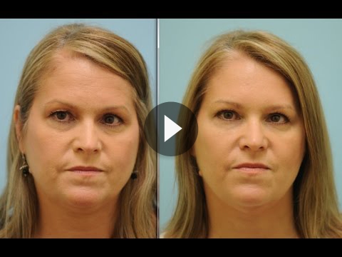 Botox Jaw Reduction Videos