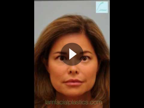 Juvederm Videos