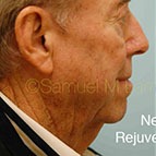 Image of a Neck Lift patient