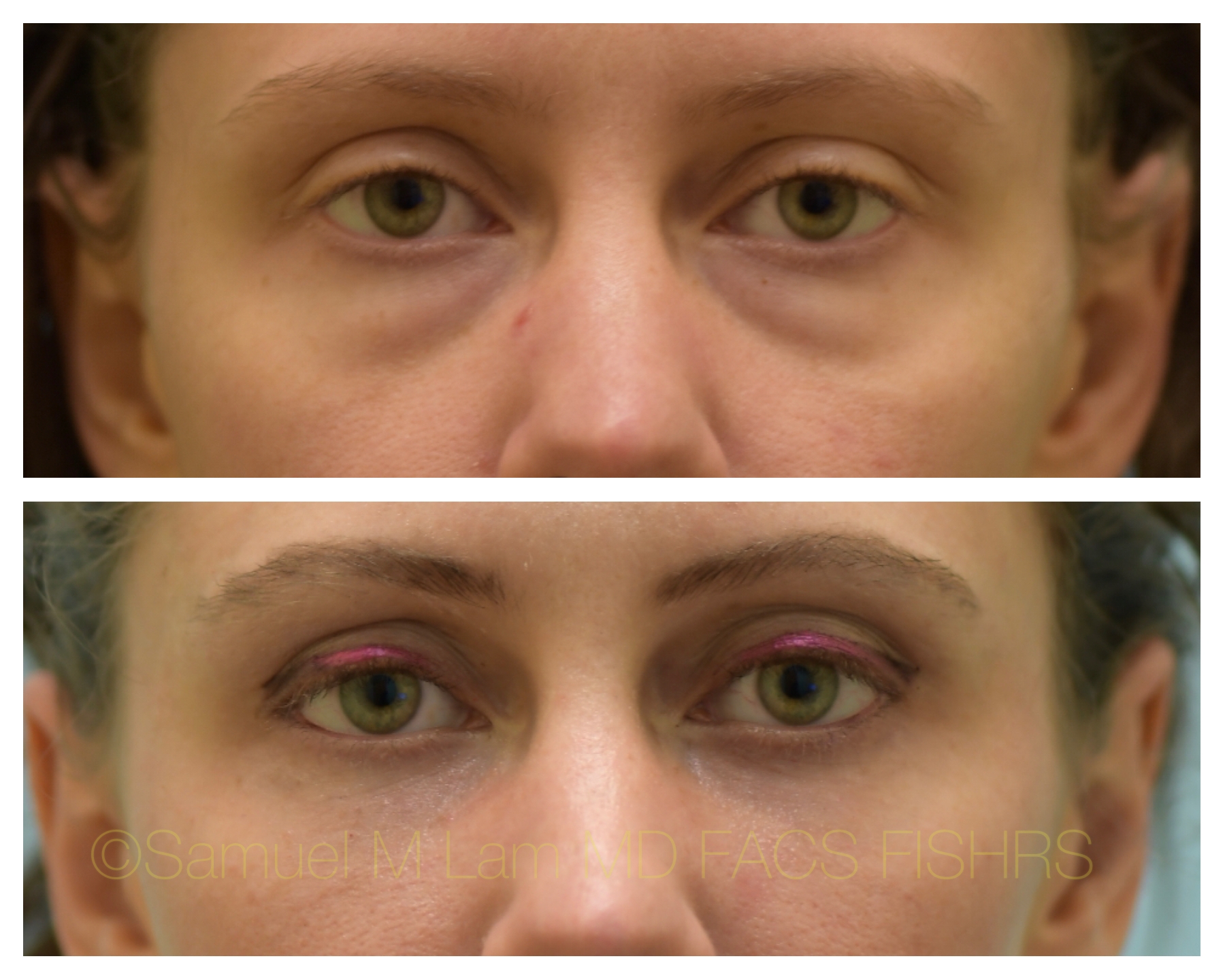 Fat Grafting Before & After