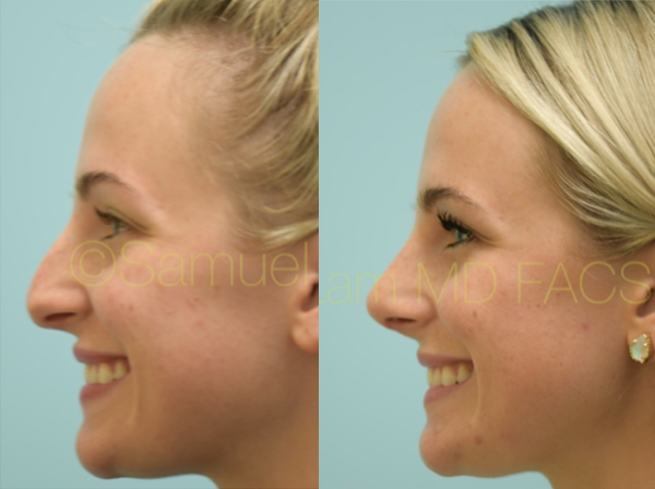 Caucasian Rhinoplasty Photos