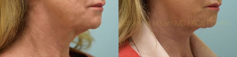 Facelift/Neck Lift