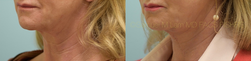 Facelift/Neck Lift