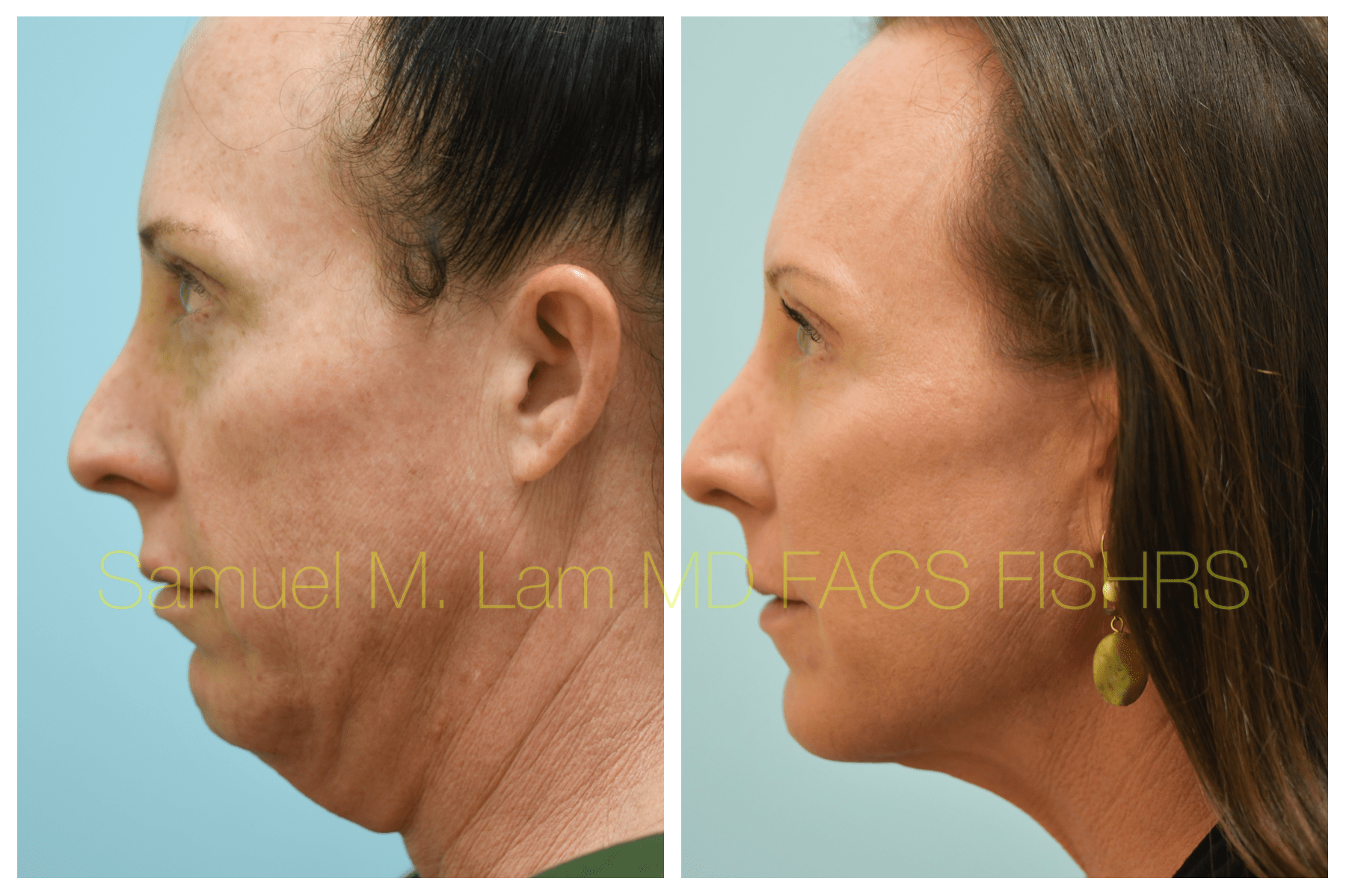Facelift