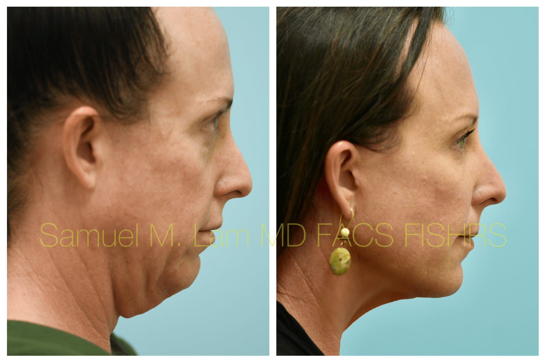 Facelift