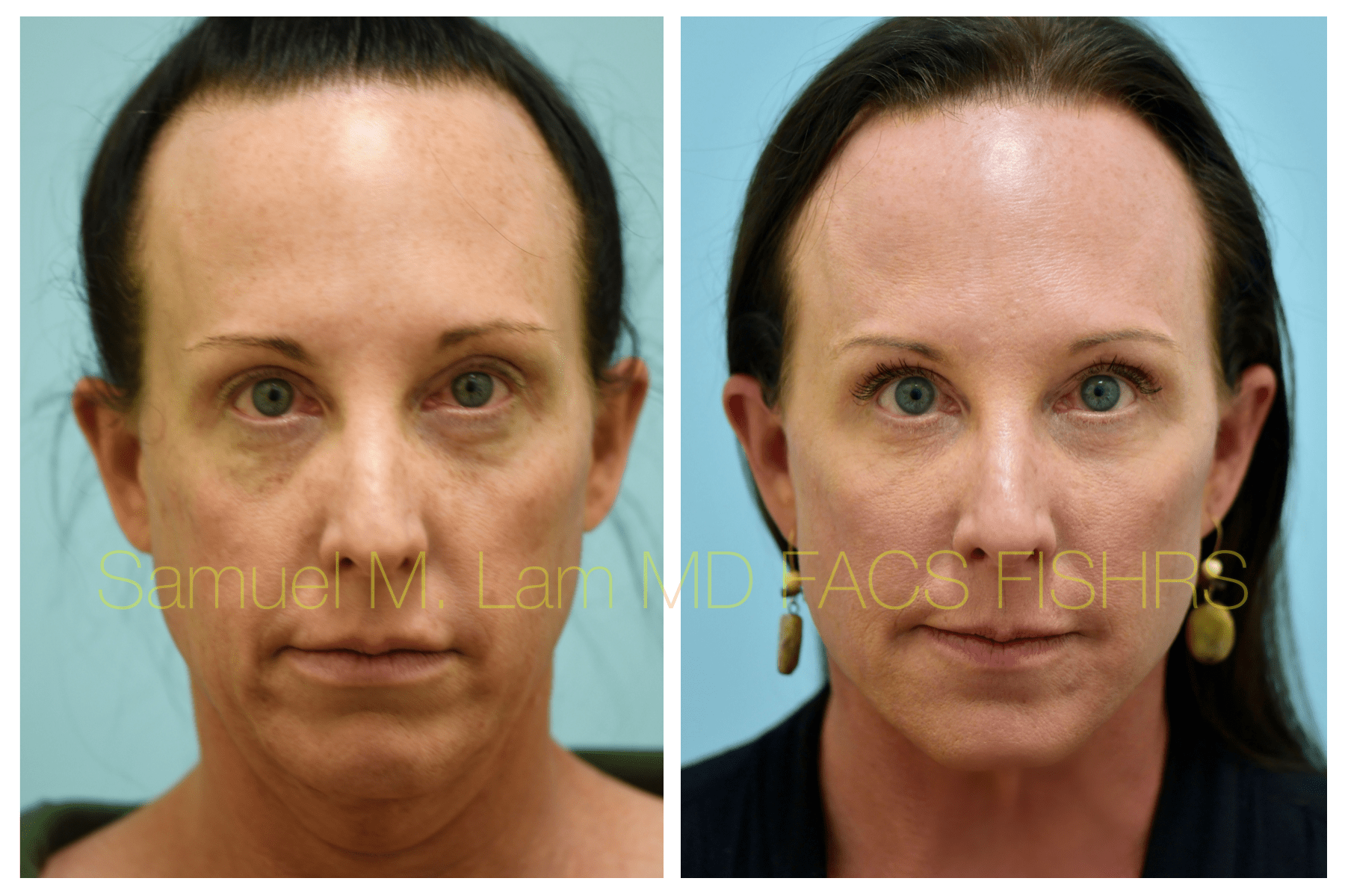 Facelift