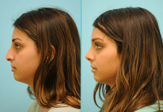 patient testimonial before and after