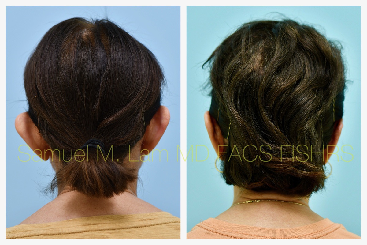 Otoplasty Before and After Photo by Dr. Lam in Plano, TX