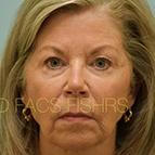 Image of a Facial Fat Grafting patient