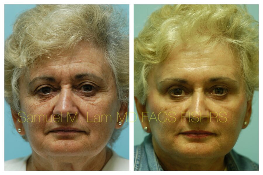 Brow Lift Surgery Dallas TX