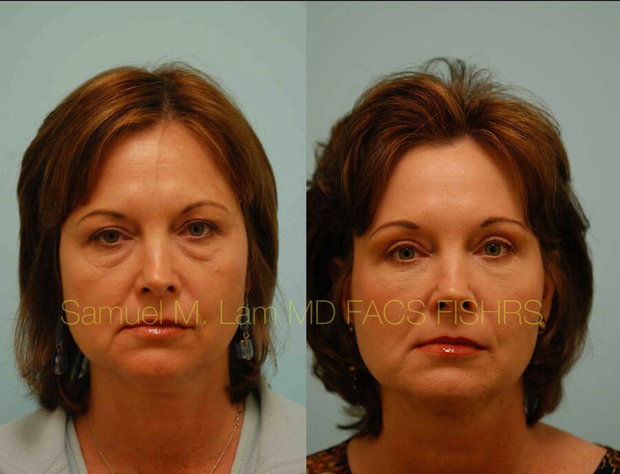 Brow Lift Surgery Dallas TX