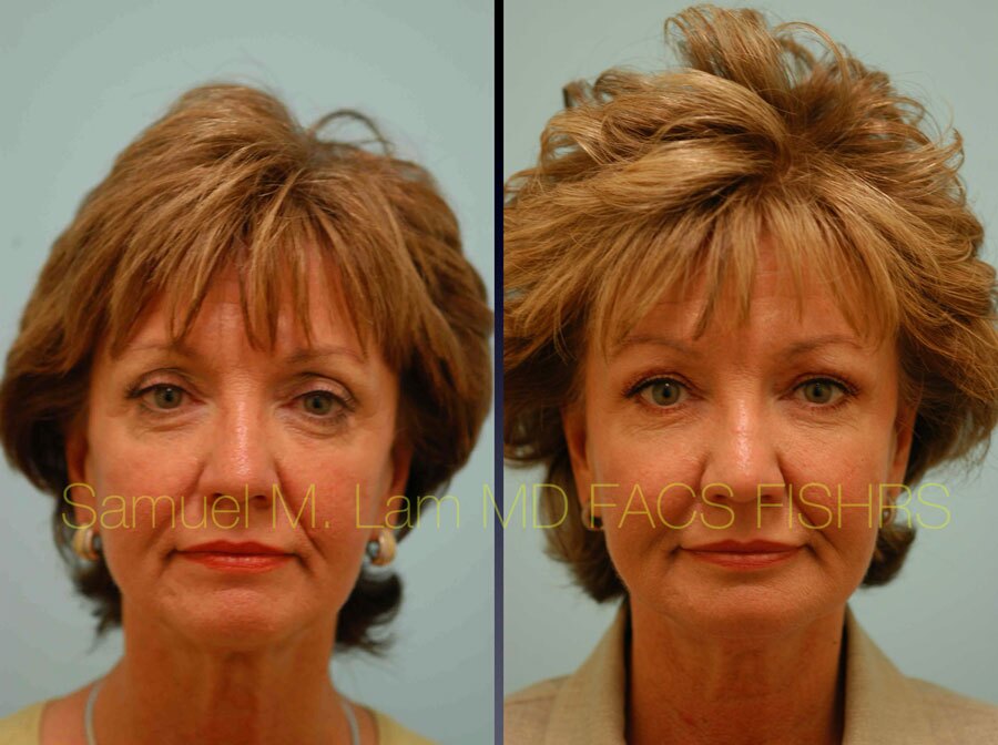 Brow Lift Surgery Dallas TX