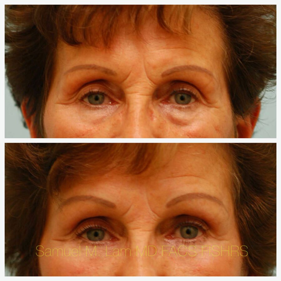 Brow Lift Surgery Dallas TX