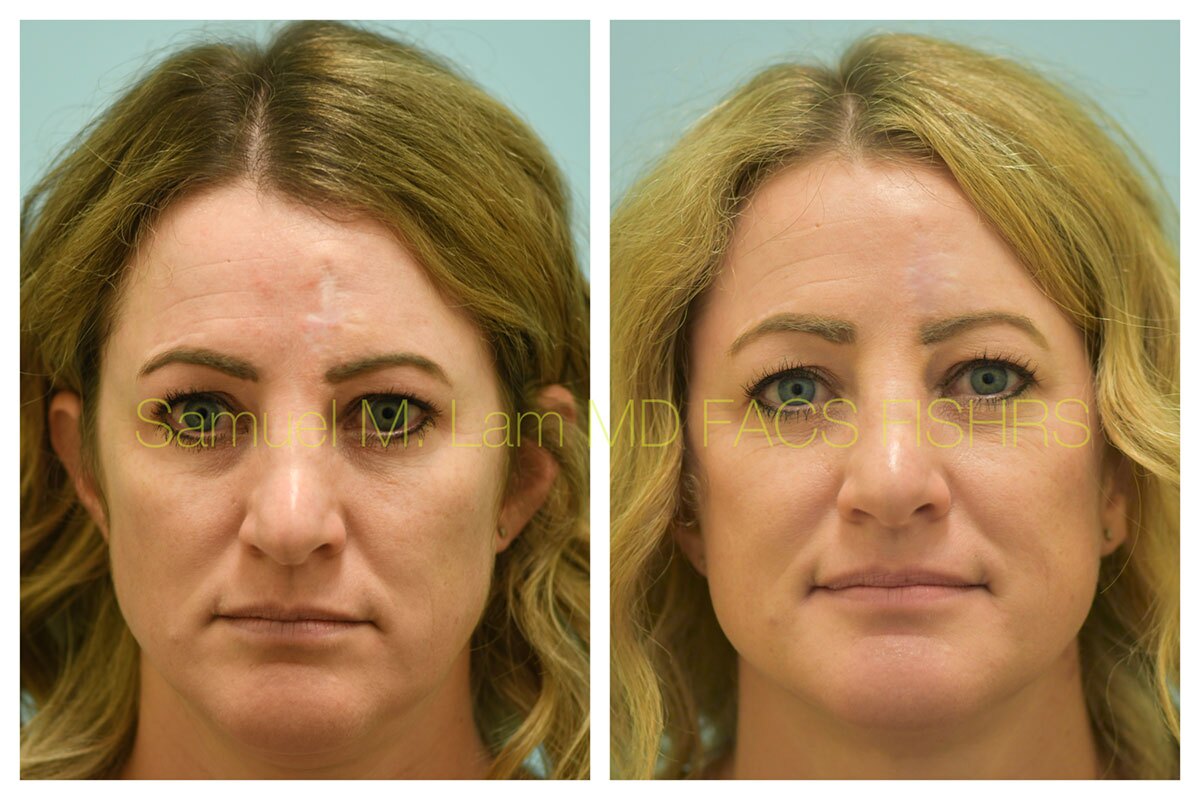 Scar Revision Before and After Photo by Dr. Lam in Plano, TX of