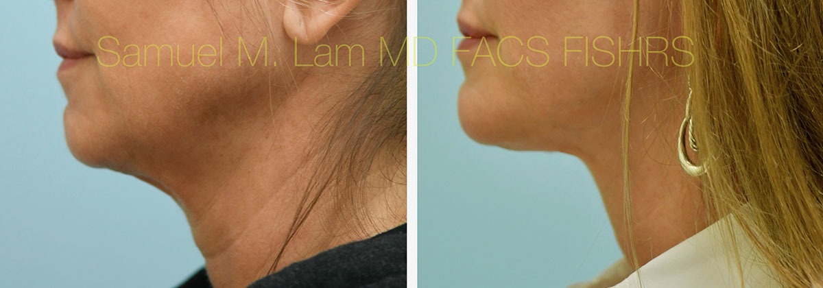 Face:Necklift Before and After Photo by Dr. Lam in Plano, TX