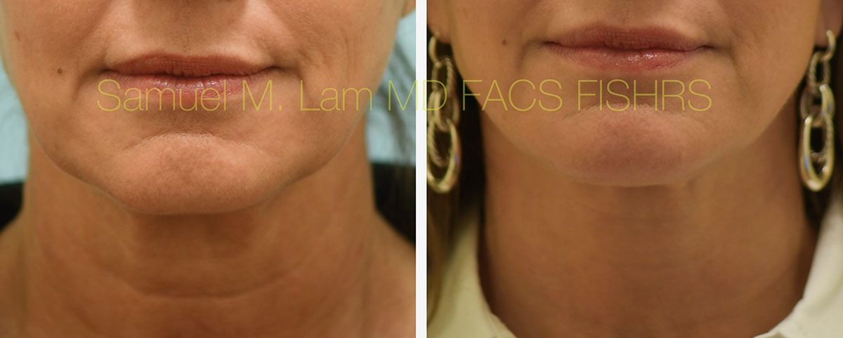 Face:Necklift Before and After Photo by Dr. Lam in Plano, TX