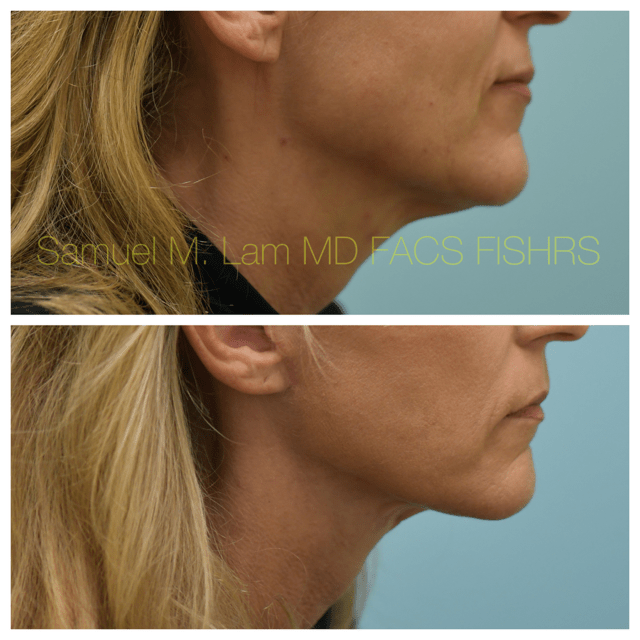 Facelift Before and After Photo by Dr. Lam in Plano, TX