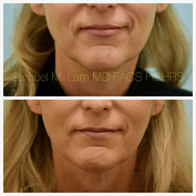 Facelift Before and After Photo by Dr. Lam in Plano, TX