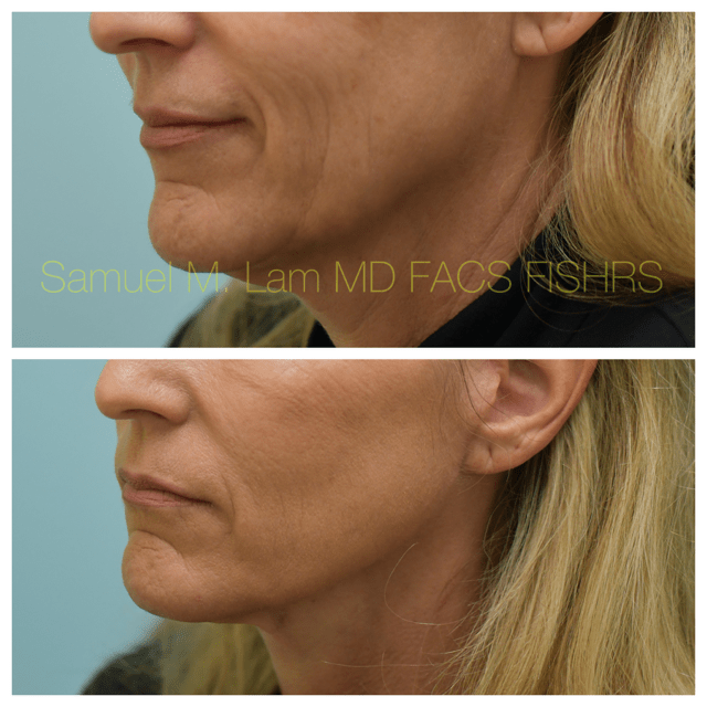 Facelift Before and After Photo by Dr. Lam in Plano, TX