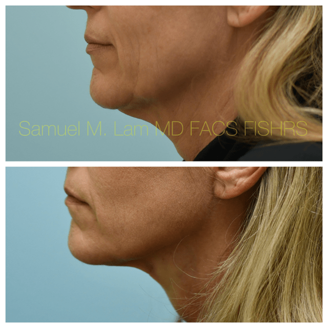 Facelift Before and After Photo by Dr. Lam in Plano, TX