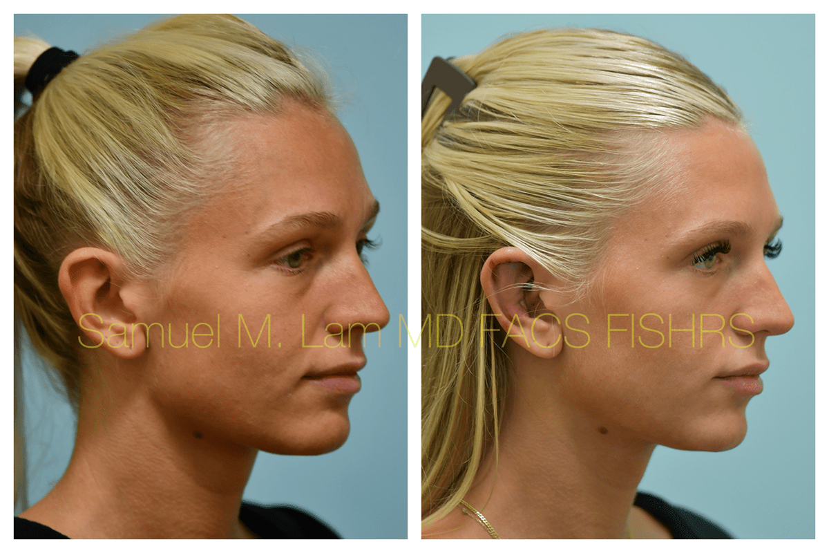 Otoplasty Before and After Photo by Dr. Lam in Plano, TX