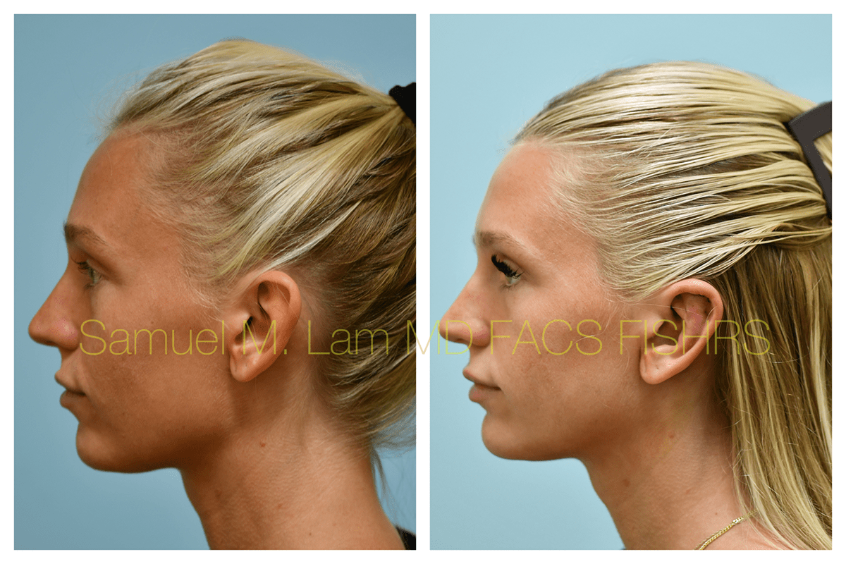 Otoplasty Before and After Photo by Dr. Lam in Plano, TX