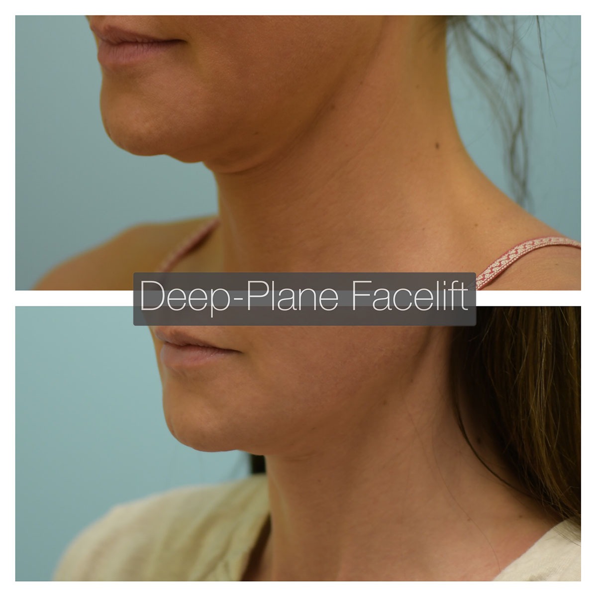 Deep Plane Facelift Before and After Photo by Dr. Lam in Plano, TX