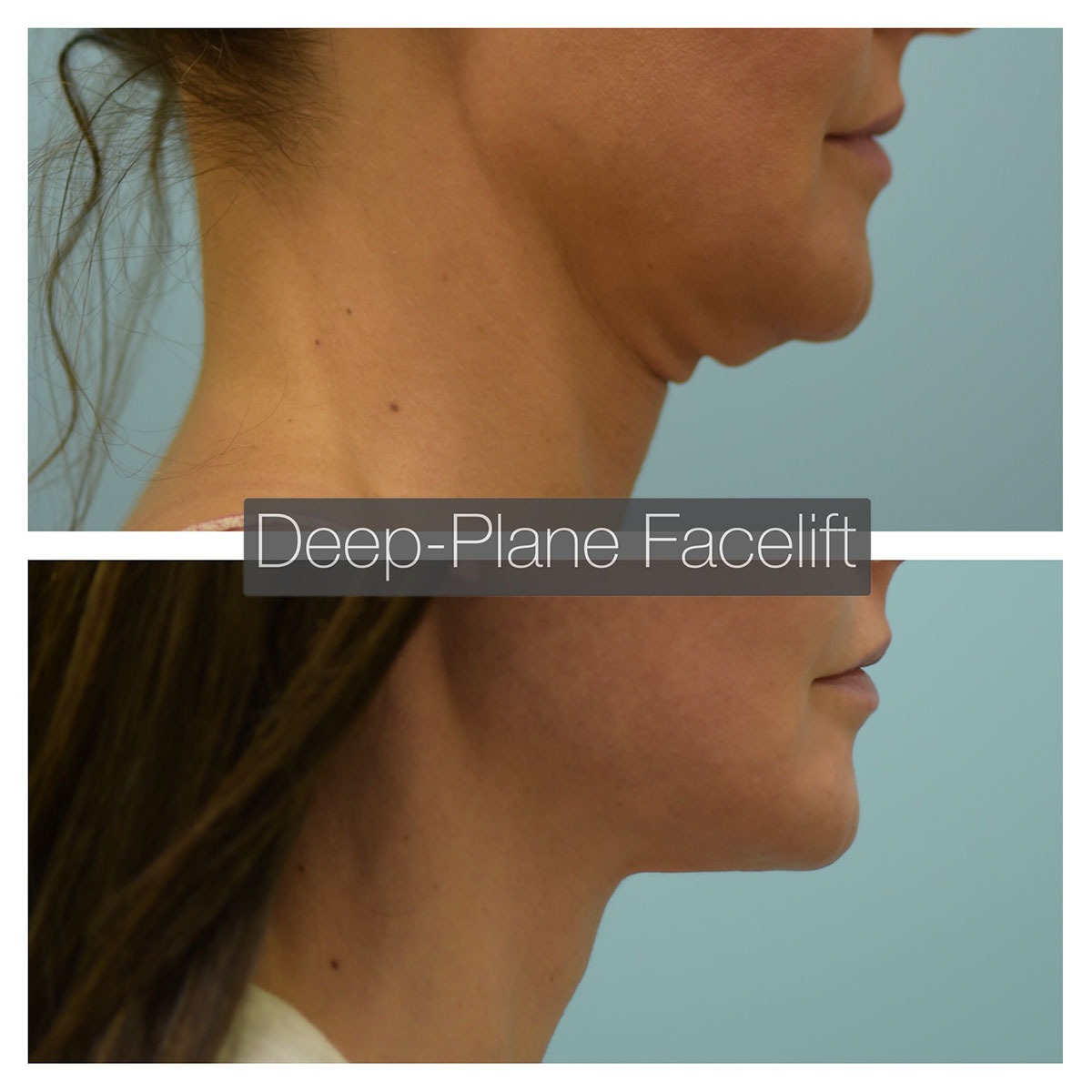 Deep Plane Facelift Before and After Photo by Dr. Lam in Plano, TX