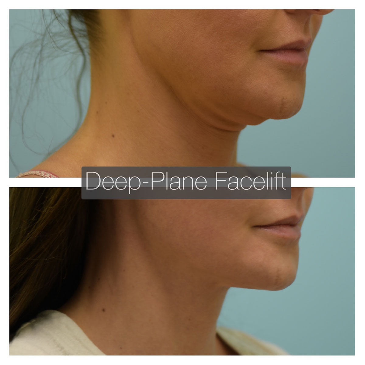 Deep Plane Facelift Before and After Photo by Dr. Lam in Plano, TX